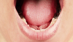 دیابت و بیماری دهان و دندان